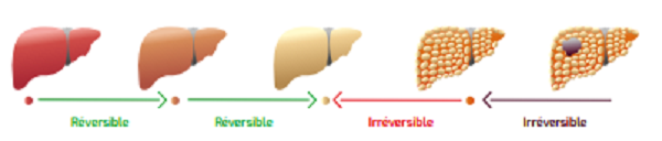maladies du foie