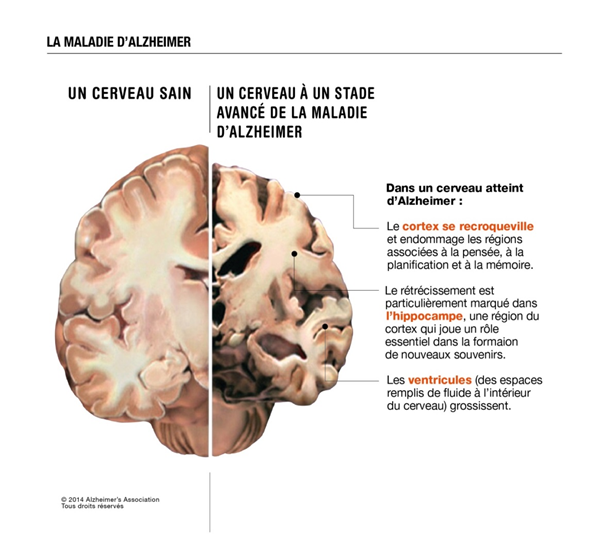 Alzheimer