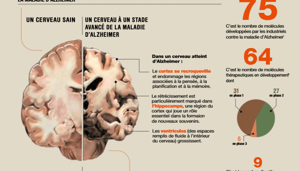 Trouvera-t-on bientôt un traitement contre la maladie d'Alzheimer ?