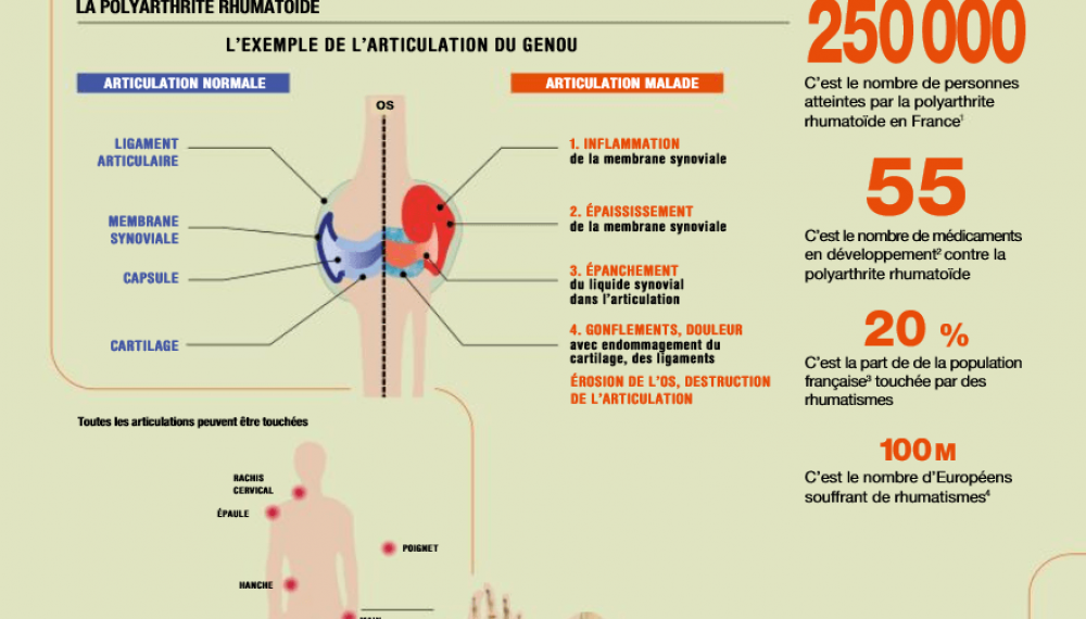 Quels progrès dans la prise en charge de la polyarthrite rhumatoïde ?