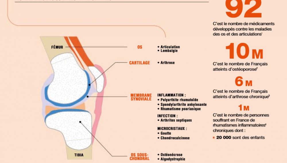 Les maladies des os et des articulations sont-elles bien prises en charge ? 
