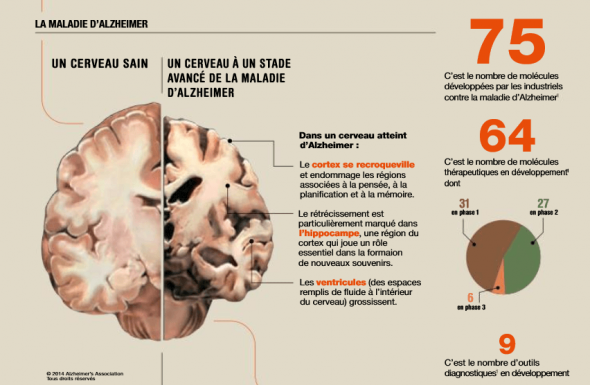 Trouvera-t-on bientôt un traitement contre la maladie d'Alzheimer ?