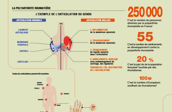 Quels progrès dans la prise en charge de la polyarthrite rhumatoïde ?